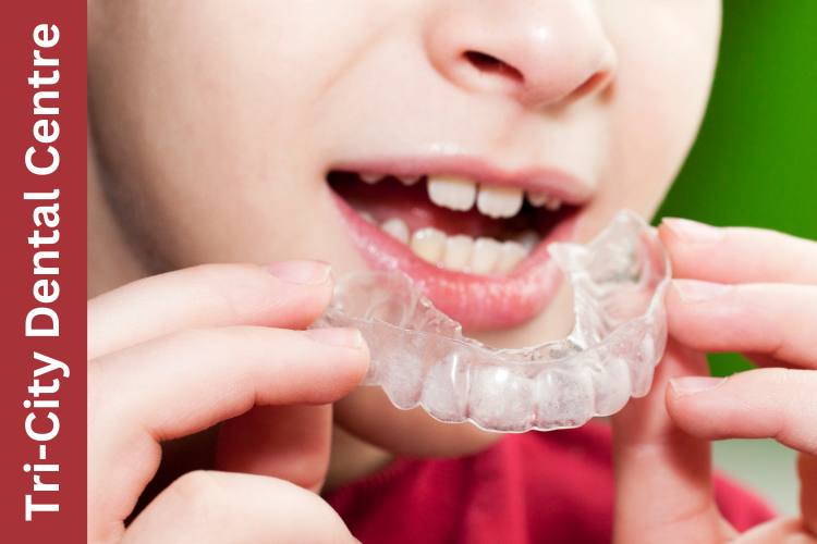 Night Guards in Coquitlam: Stop Teeth Grinding and Protect Your Smile