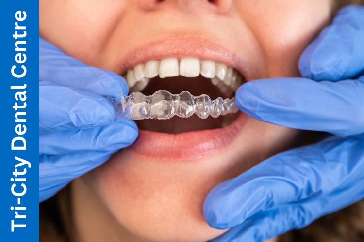 orthodontics for adults in Coquitlam