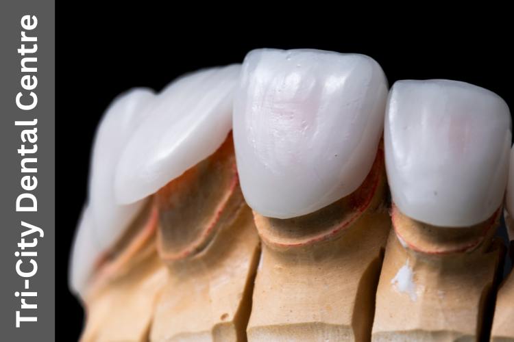 veneers vs bonding Coquitlam