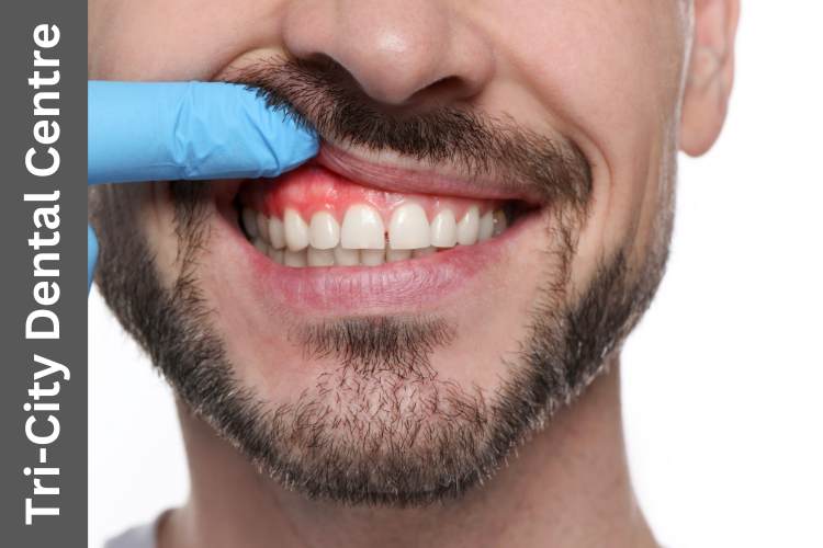 Gum Disease Treatment and Prevention in Coquitlam