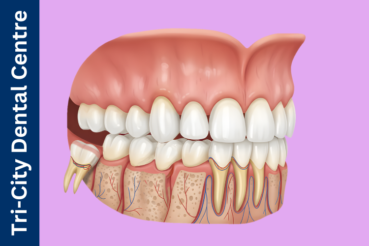 wisdom teeth removal Coquitlam
