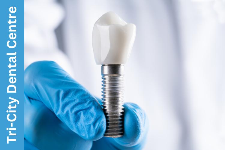 dental implants Coquitlam