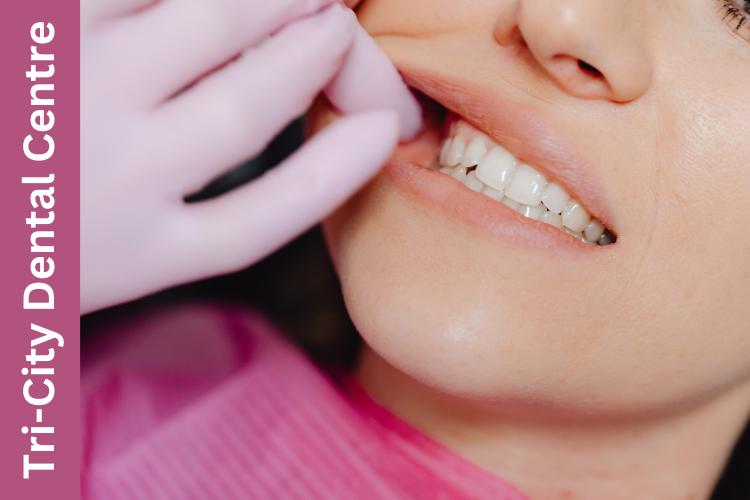 teeth-grinding-treatment-coquitlam