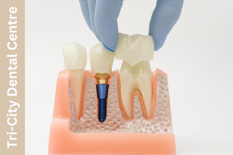 dental crowns in Coquitlam