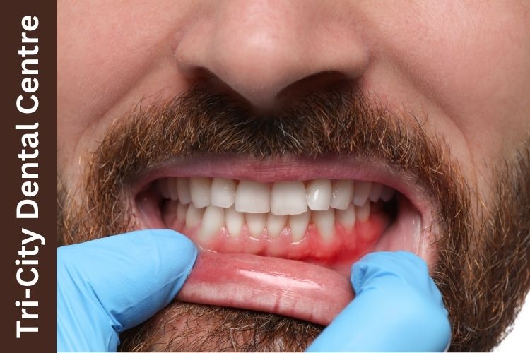Bleeding Gums Without Pain | Coquitlam Dentist