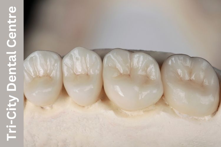 tooth feels high when biting Coquitlam