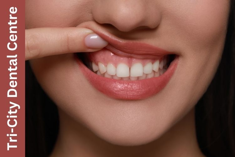 itchy teeth and gums Coquitlam