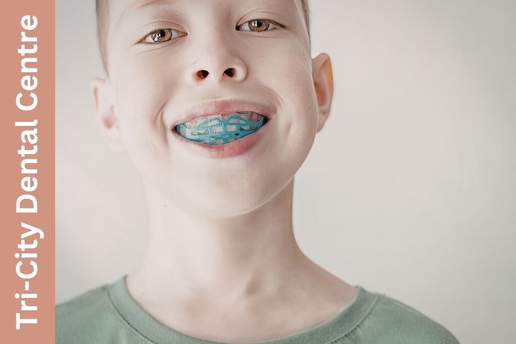 Sports mouthguard Coquitlam